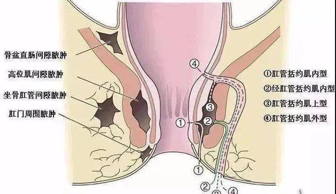 女性肛门下坠图片