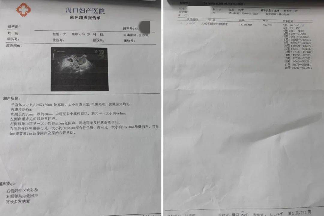 宫外孕b超检查报告单图片