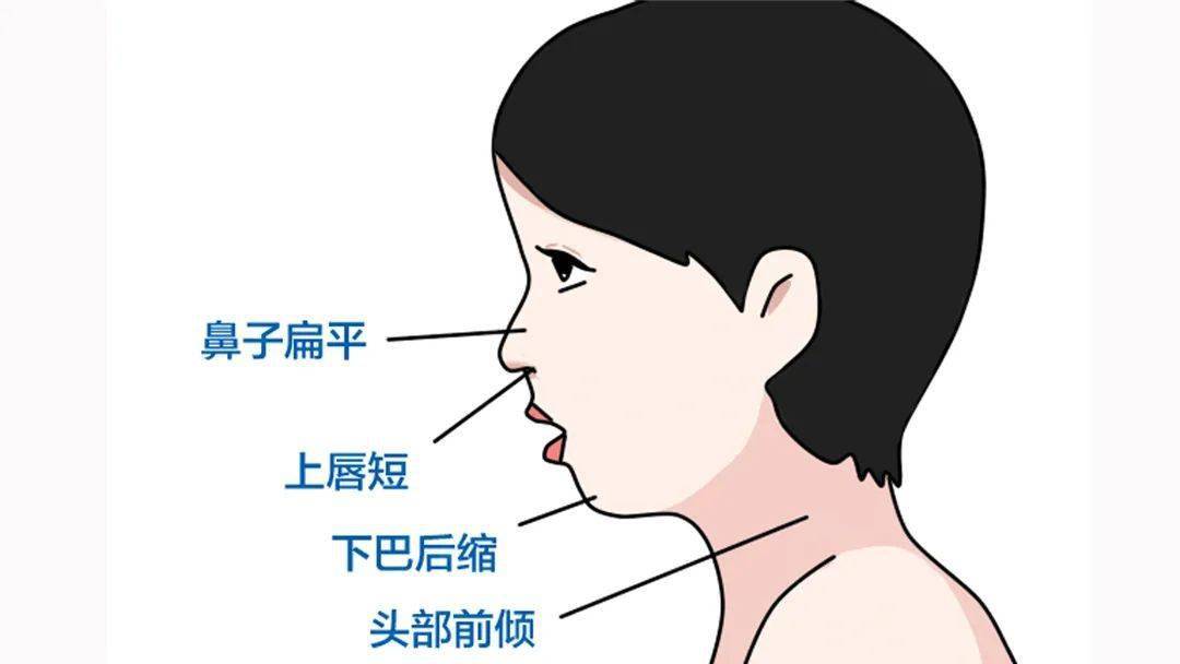 主要原因就是孩子的腺样体长期肥大,导致鼻腔长期堵塞,同时长期张口