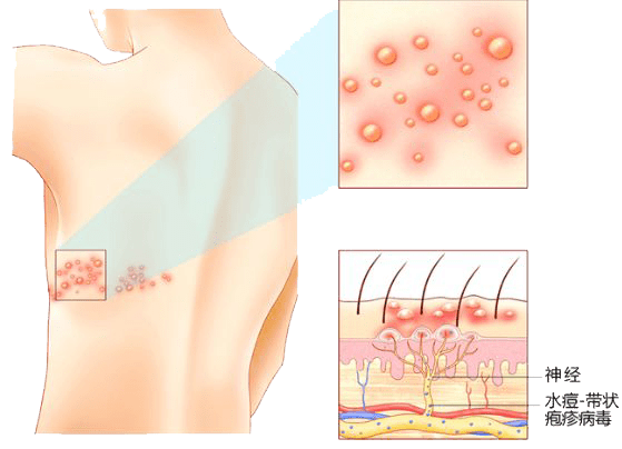 疼痛程度最高可达十级,季节交替谨防带状疱疹!