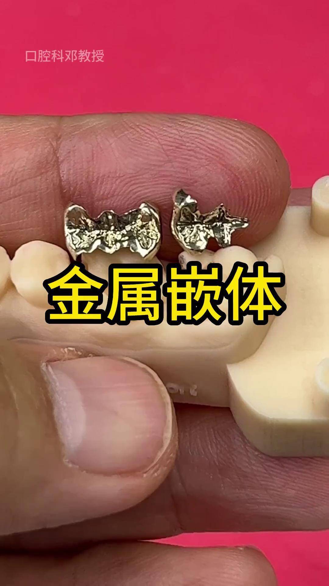 闪闪发光的金属嵌体,你见过吗?口腔科普 嵌体 口腔科邓教授
