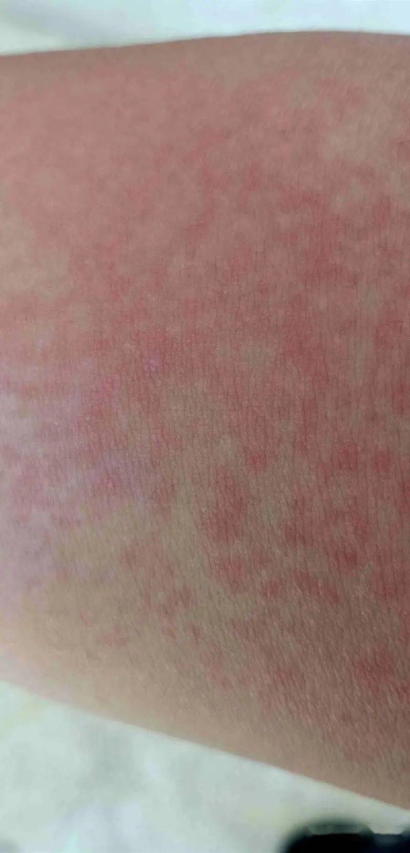 毛发重新长出的速度惊人!超四成脱毛膏消费投诉涉过敏等问题
