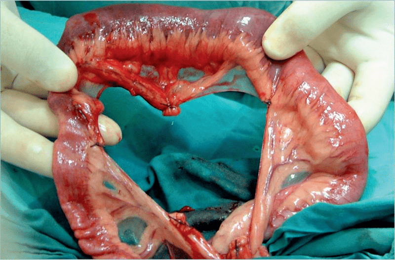 外科实用技术图谱19张图片视频详解肠切除术