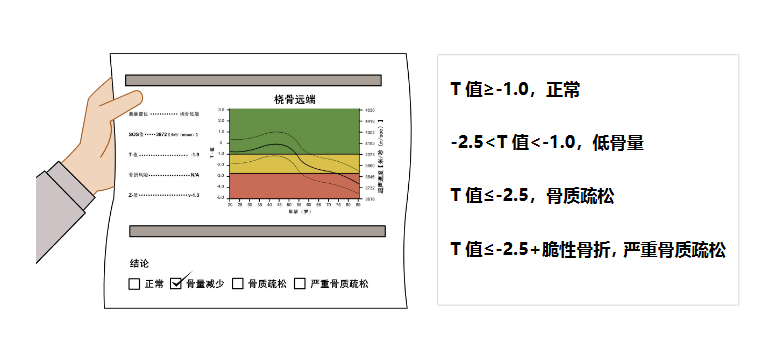 骨密度通常用 t 值来表示,即您与同性别,同种族健康成人的骨峰值的