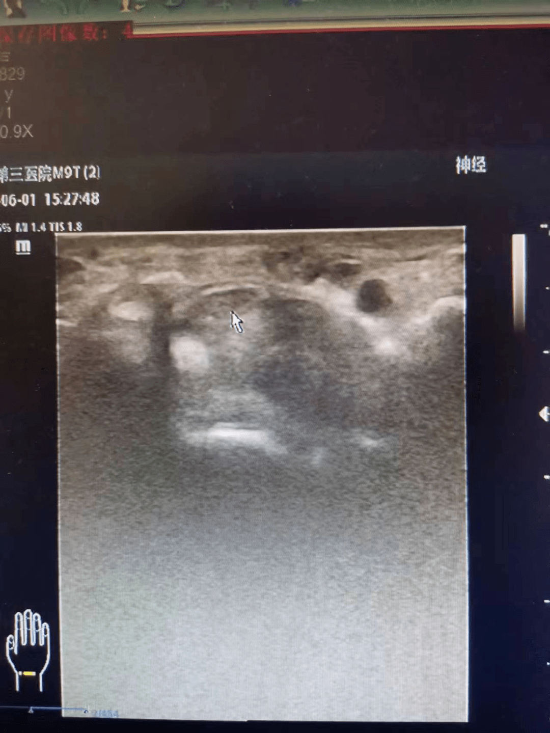 "鼠标手"——肌骨超声腕管综合征_手指_检查_活动