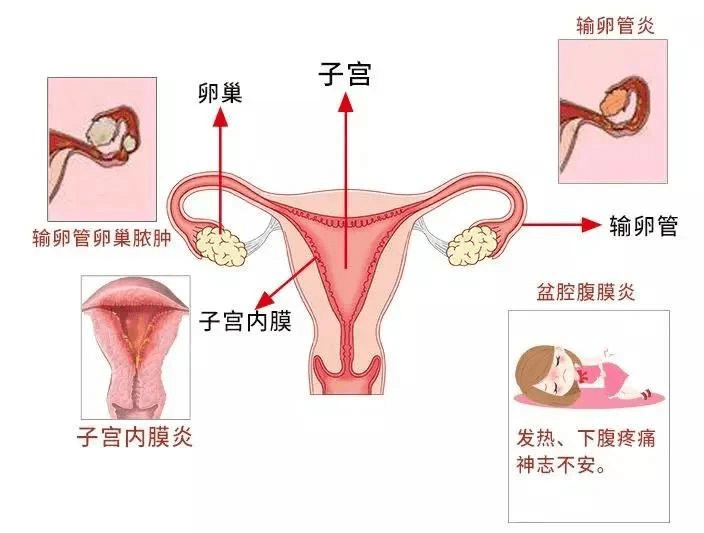 小心聚宝盆里的炎症