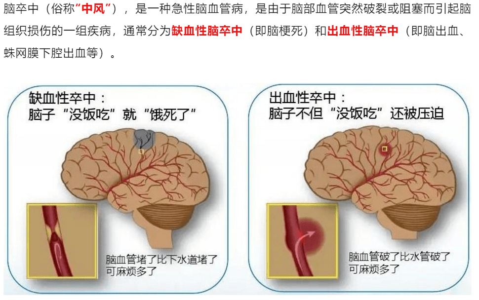 脑梗死病因图片