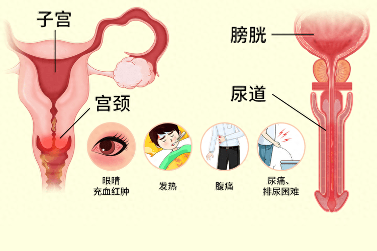 尿道口脓性分泌物图图片