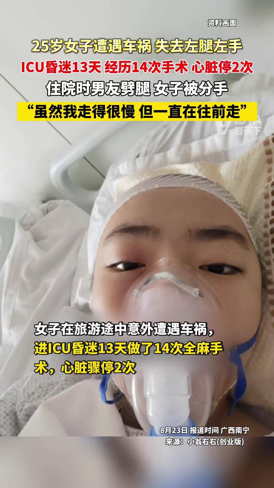 25岁女子遭遇车祸 失去左腿左手,icu昏迷13天 经历14次手术 心脏停2次