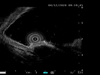 超聲內鏡診療技術--黏膜下腫瘤part.
