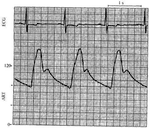 正常人血压脉搏曲线图图片