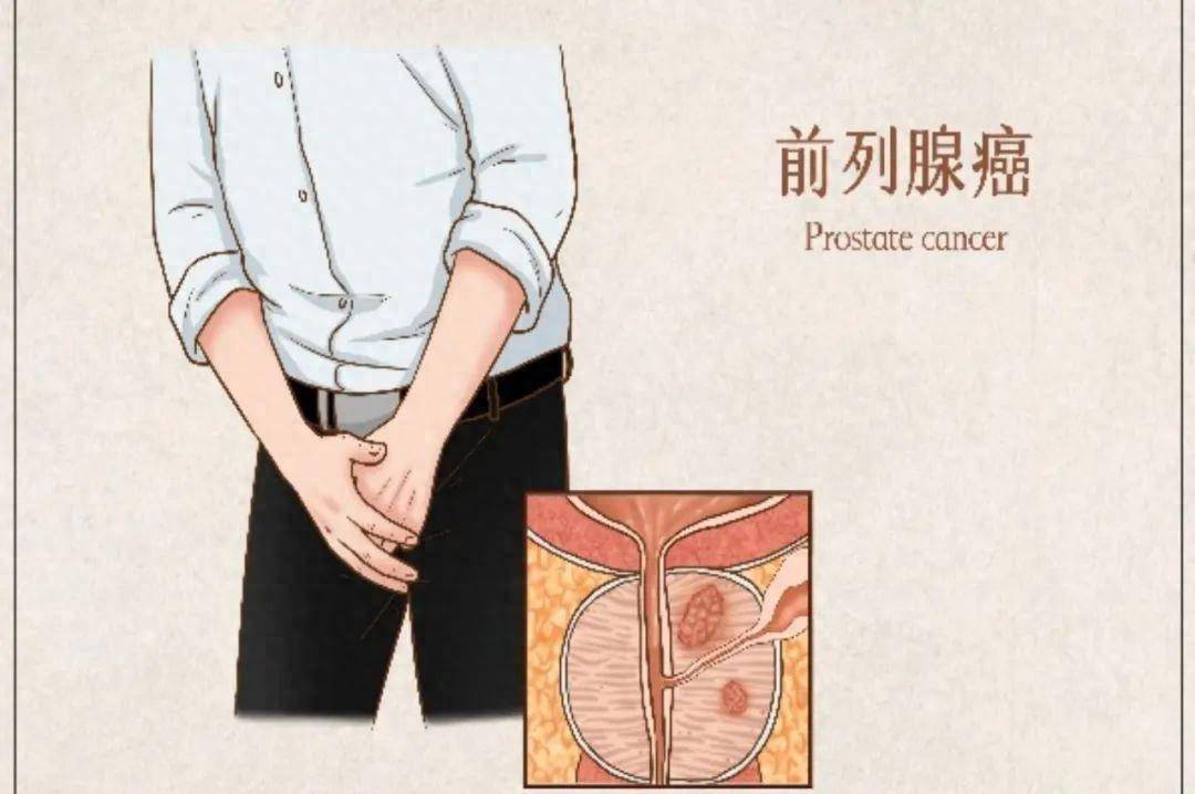 前列腺癌治疗,警惕骨质疏松!_患者_简阳_市人民医院