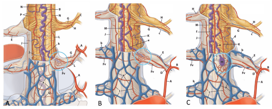 锥束ct在硬脊膜及硬脊膜外动静脉瘘的治疗与诊断中的作用_脊髓_血管
