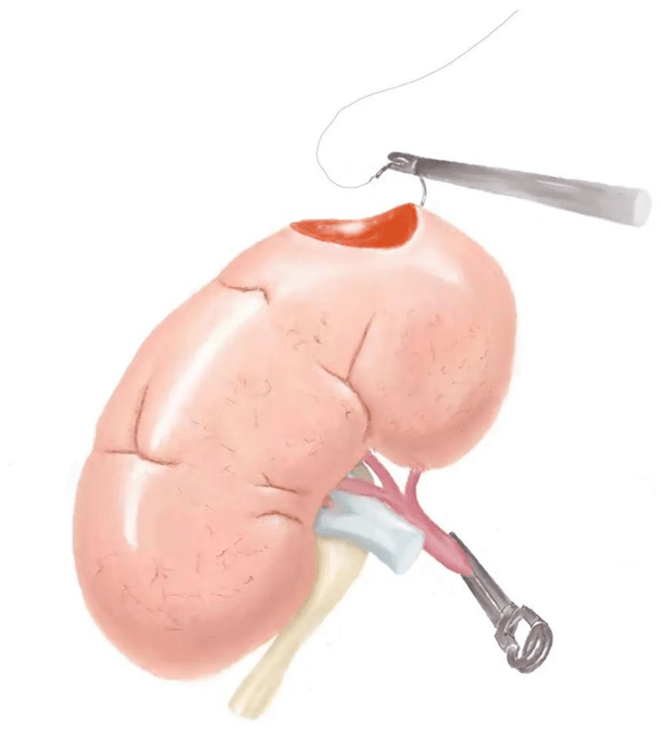 肾囊肿的手术图解图片
