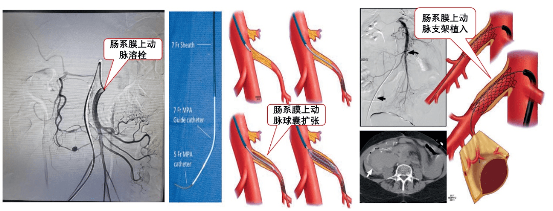 肠系膜上下动脉血管图图片