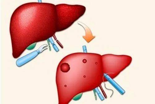 杏林百科 | 体检查出肝囊肿,需要进一步检查吗?_治疗_手术_肝脏