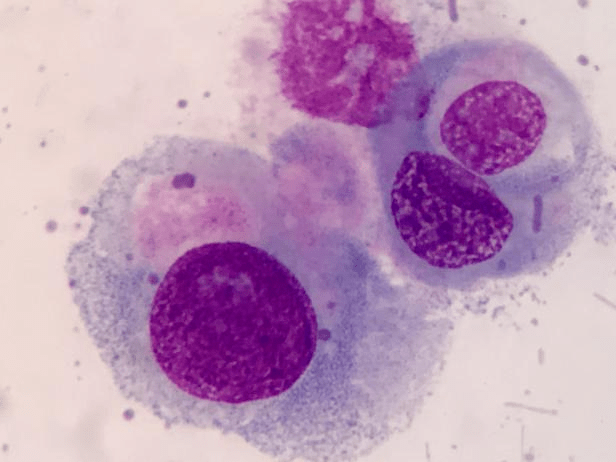 优胜奖:尿沉渣细胞学检出肾癌一例_诊断_检查_患者