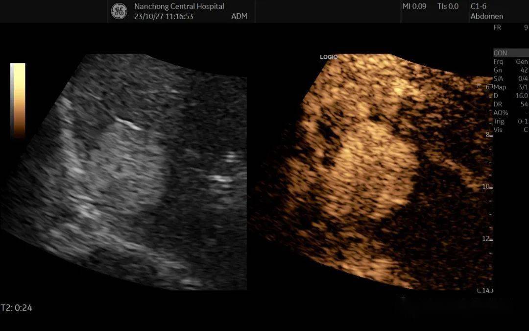 錯構瘤,而是首先給大家分享一個微泡增強超聲檢查(即通常所說的超聲