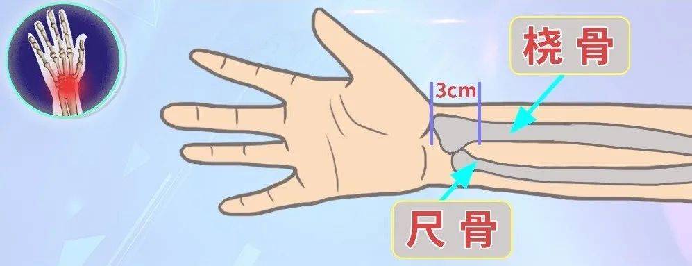 【健康医声】桡骨远端骨折康复训练_活动_锻炼_屈伸