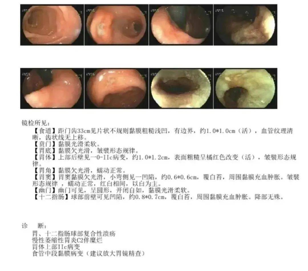 做胃镜必看!报告出现这些字眼,需要高度警惕_诊断_病变_黏膜