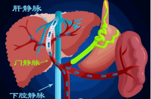 TIPS手术——肝硬化门脉高压出血的最后一道防_门静脉_患者_治疗