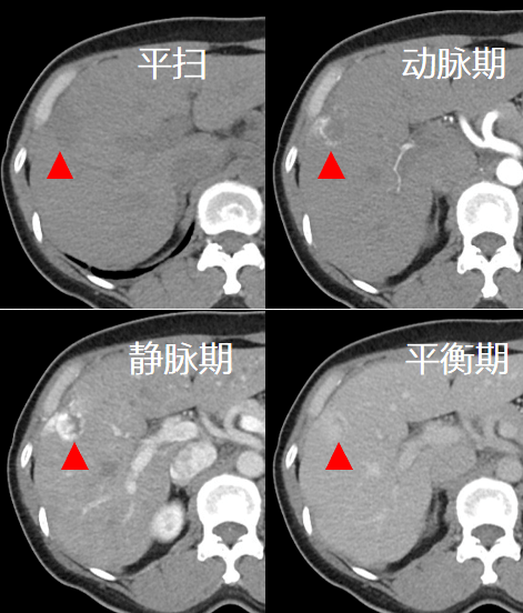 科普| 增强ct—去掉病灶的"隐身衣"_检查_病变_进行