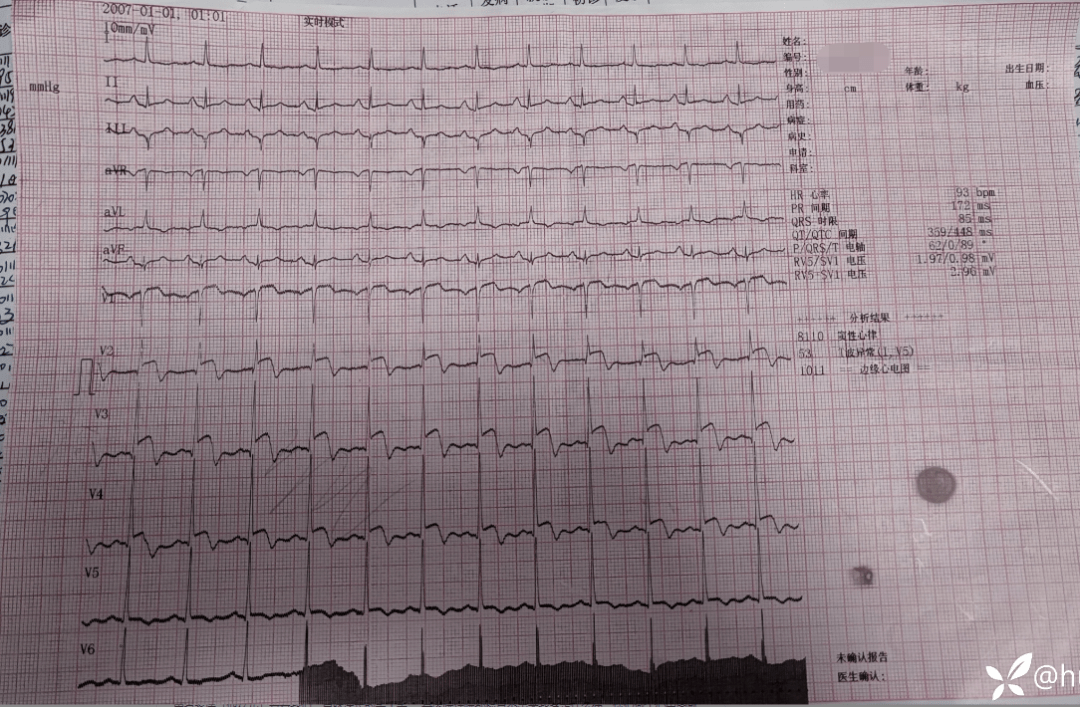 向心梗患者下病危,回应却是家属意味深长的一笑_检查_心电图_丁香园