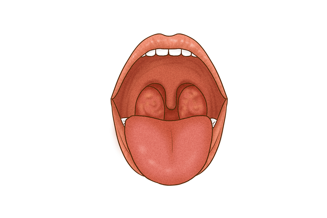高热,咽痛,警惕秋冬季高发的急性扁桃体炎!