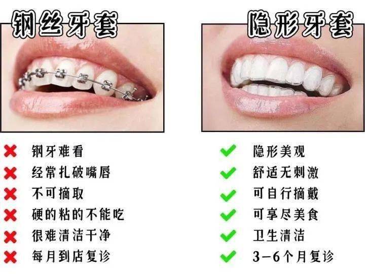 你还在纠结要不要整牙,来看看我整牙3年后的变化…_牙齿_影响_钢牙