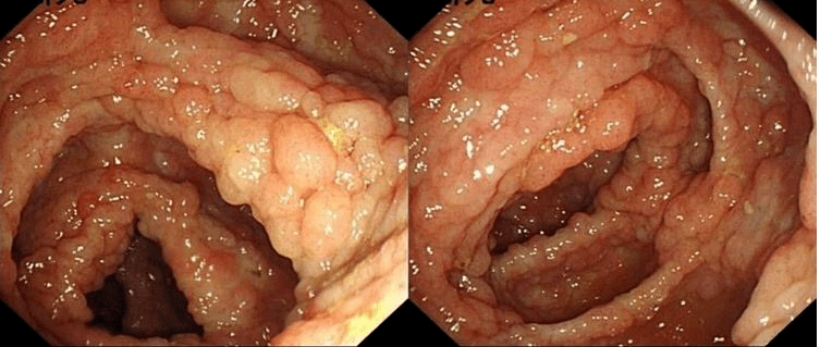 肠息肉图片癌变图片