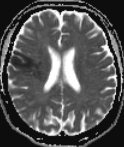 術前dwi adc:未見出血,aspects-ct 10分.