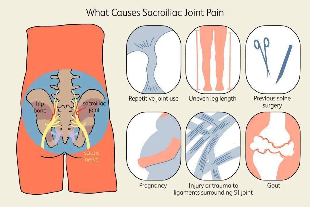 骶髂關節疼痛的原因及緩解技巧_活動_骨盆_軟骨