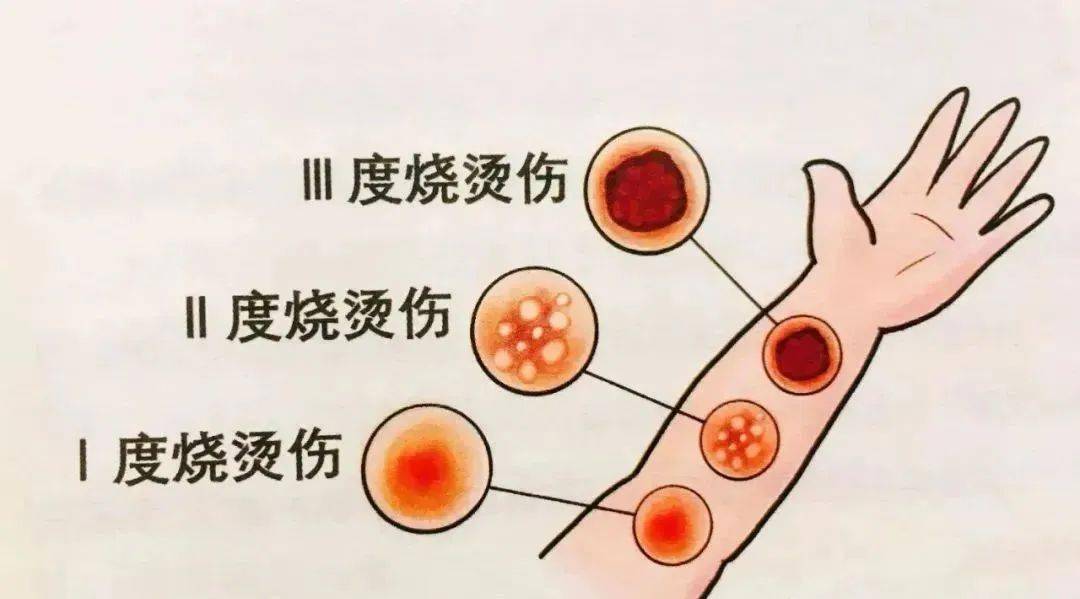 烧伤严重程度分度图片图片