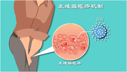 肛周疱疹是什么原因图片