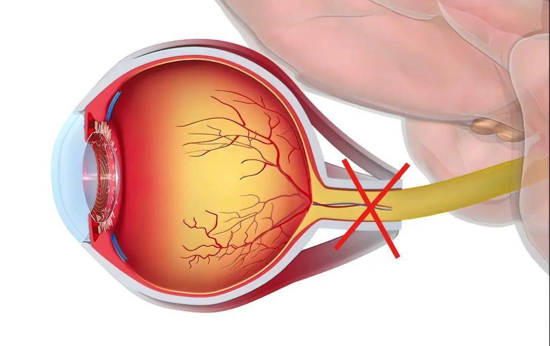 警惕不可逆的视力损伤,这5类人更容易患青光眼_患者_显示器_视野