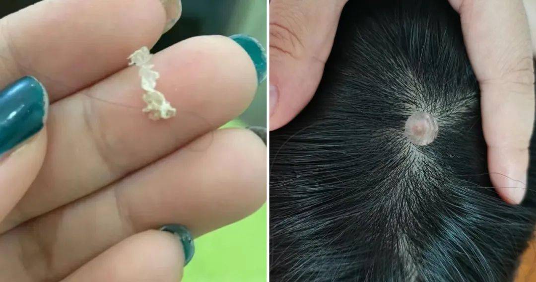 头皮上抠出来的大片结痂,到底是什么东西啊?_头发_洗头_去屑
