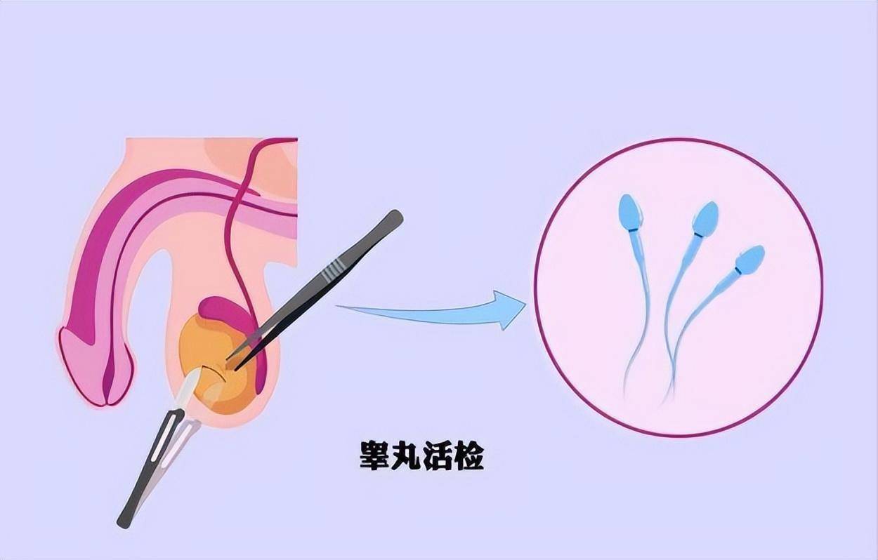 睪丸顯微取精術睪丸顯微取精術是藉助超高清手術顯微鏡通過顯微鏡外科