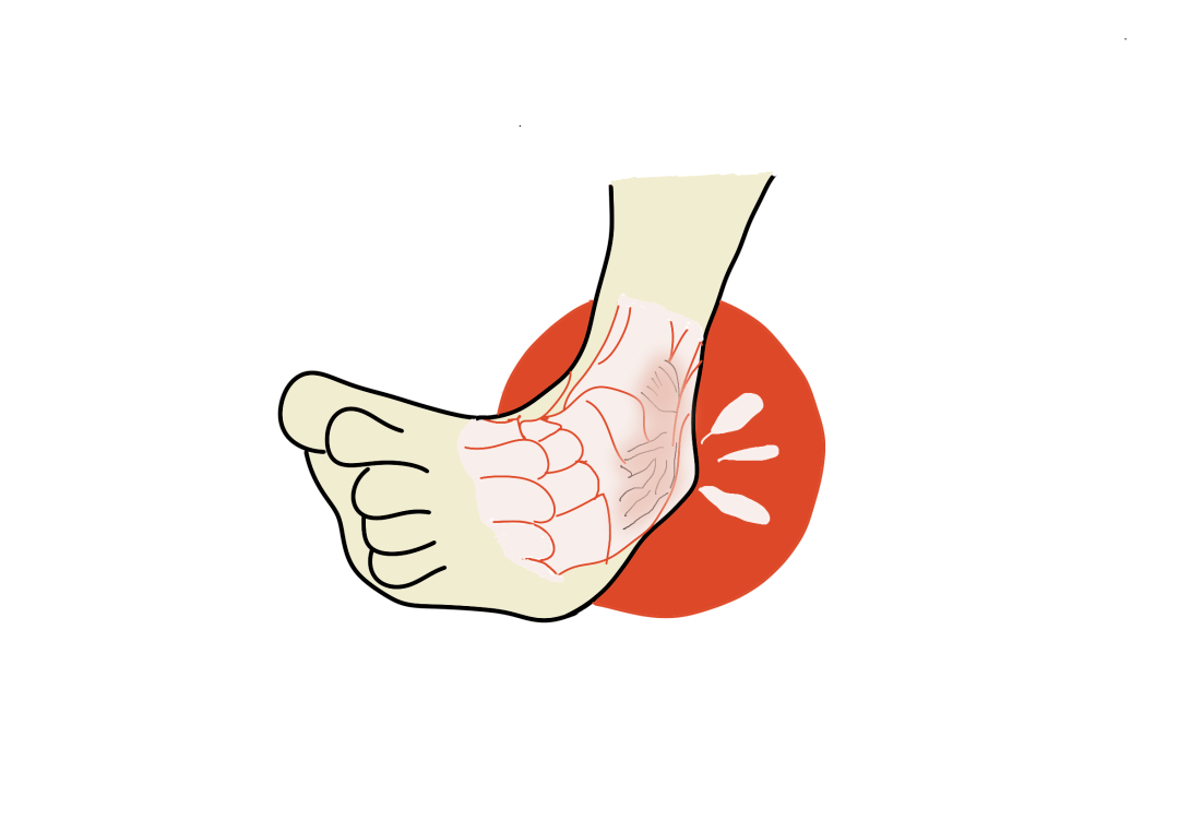 "崴脚"莫轻视,处理要及时