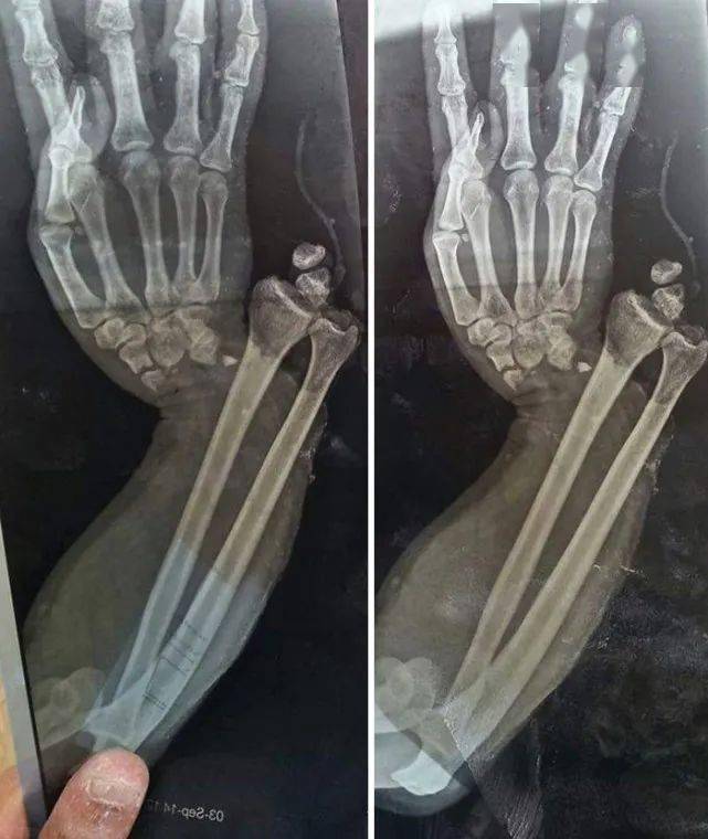 手脱臼的诊断报告照片图片
