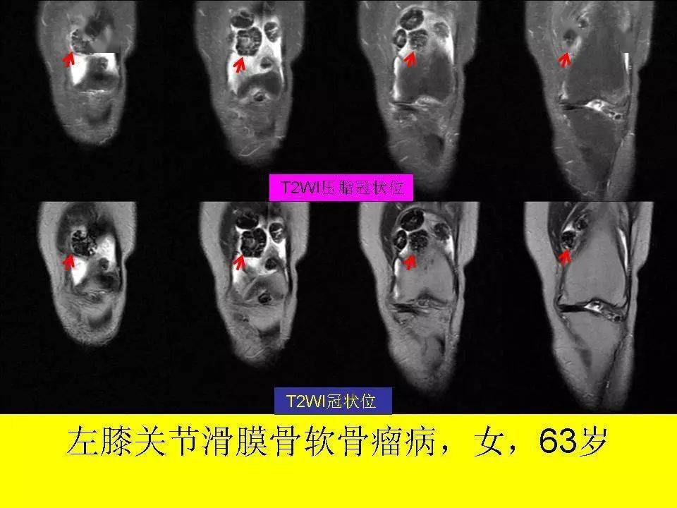 mri表現ct影像x線表現首先,讓我們看看滑膜骨軟骨瘤的真面目收集我院