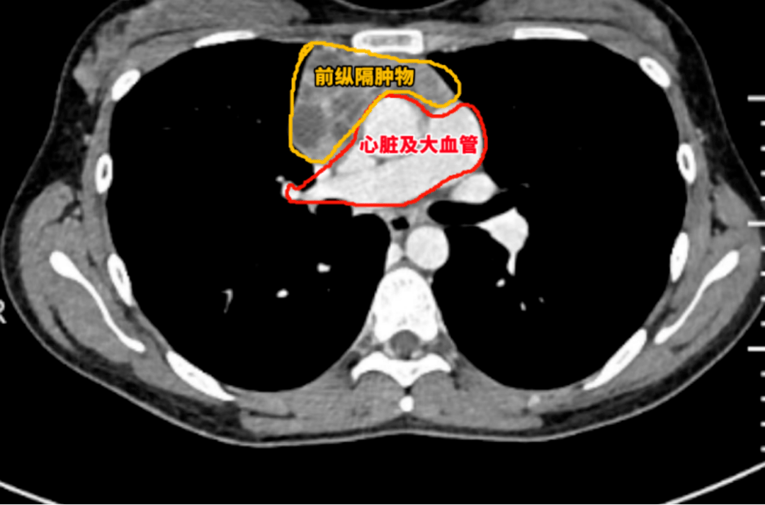 心脏癌的图片图片