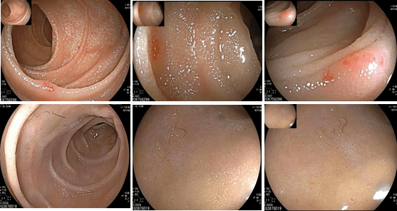 新技术 | 小肠镜——带你揭开小肠疾病的"疑难杂症"面纱_检查_内镜
