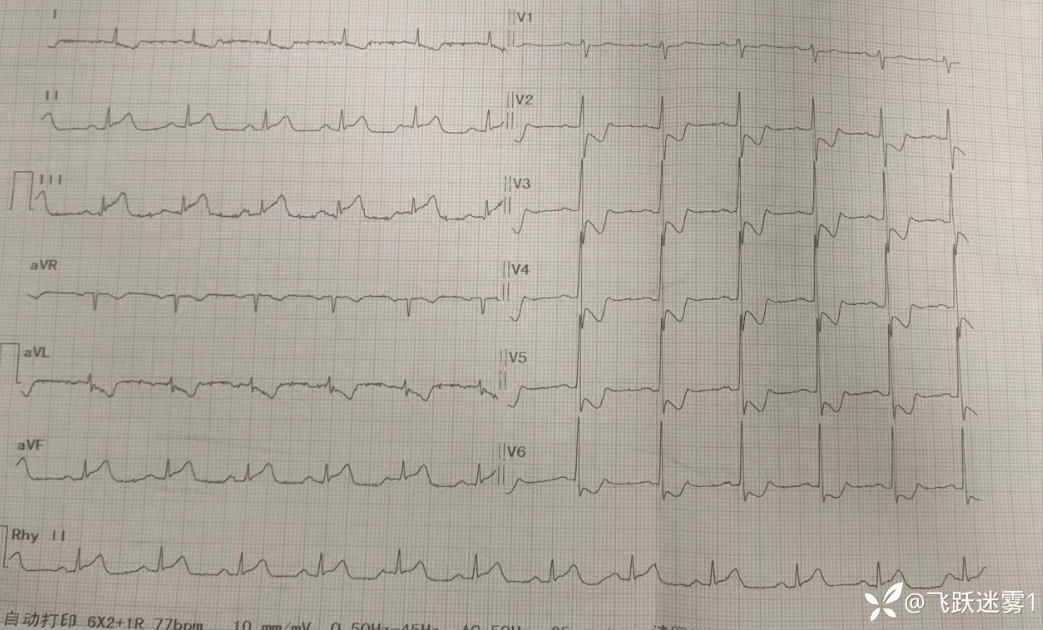 心衰心电图图片