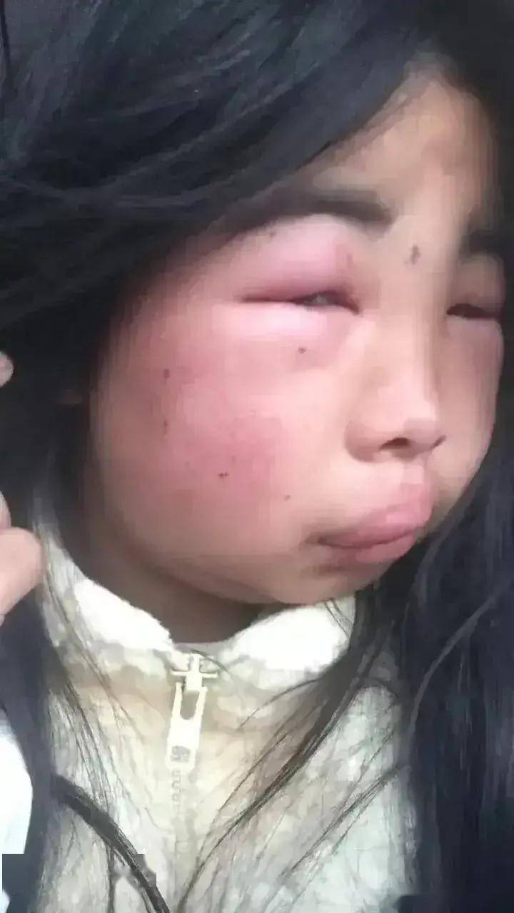 12岁女孩遭多名女同学暴打,致耳膜穿孔,被打情节曝光后网友怒了