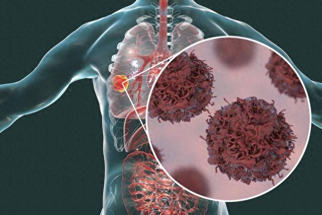 肺癌一查就是晚期?肺癌早期的五大征兆,别不当回事!