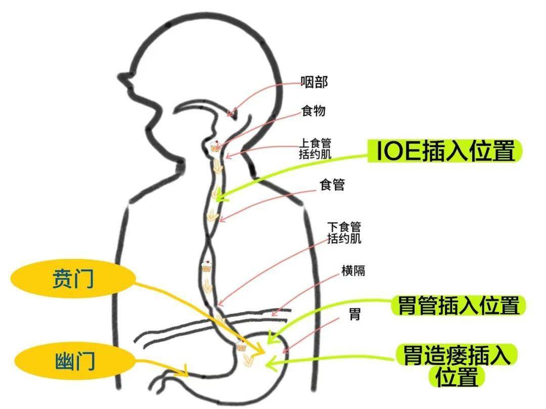 鼻肠管置入方法线路图图片