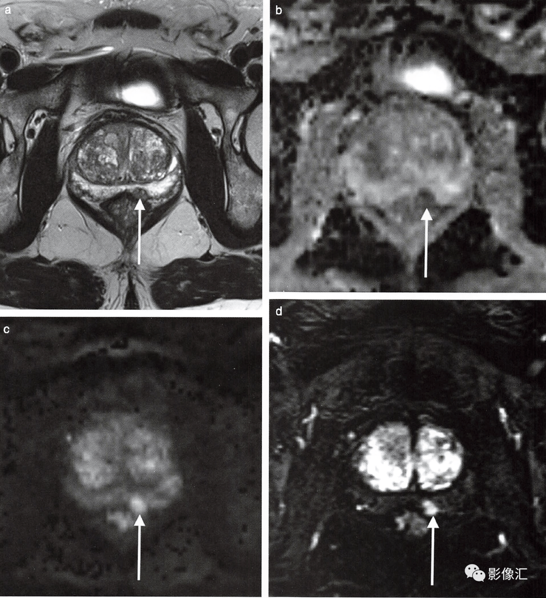 前列腺癌的mr诊断,这些陷阱需要特别注意!