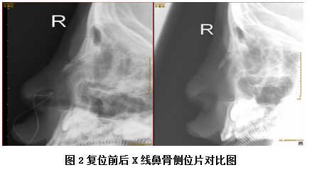 医生:不要慌,尽早复位_鼻腔_检查_孙晓卫