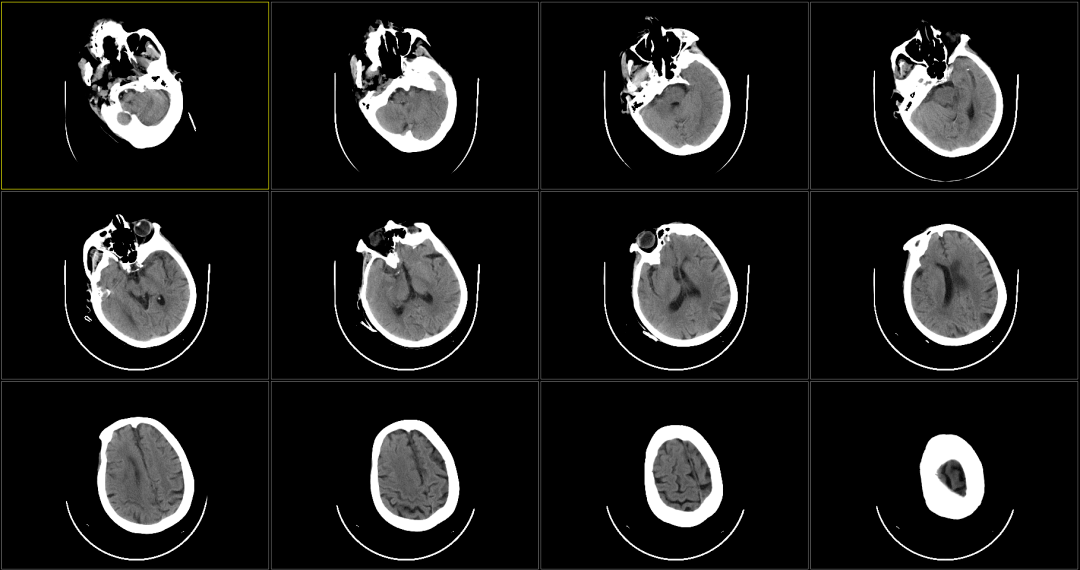 術前頭顱ct:雙側基底節區多發腔隙性腦梗死;雙側腦室旁缺血灶;腦萎縮