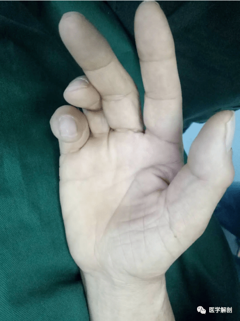 鼠标玩多了,这三条管可能会发生问题_神经_解剖_正中